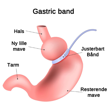 Gastric band