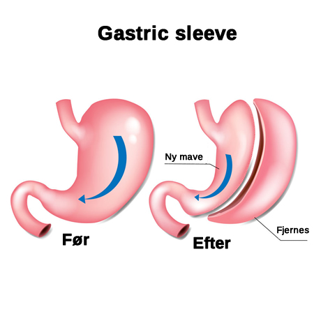 Gastric sleeve
